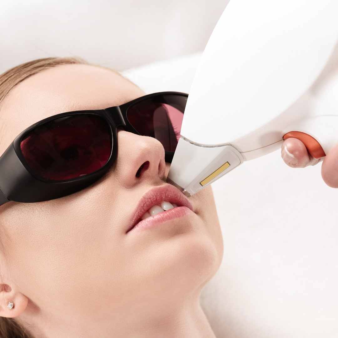 Upper Lip Laser Luxe